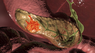 آیا این باکتری سرطان کشنده پانکراس را درمان می کند؟