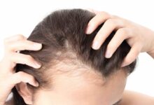 درمان جدیدی برای رشد مجدد مو در بیماران خودایمنی
