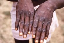 شیوع بیماری کشنده در آفریقا