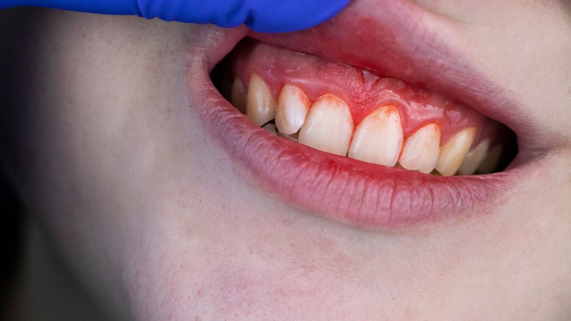 چه بیماری هایی باعث عفونت دندان و لثه می شوند؟